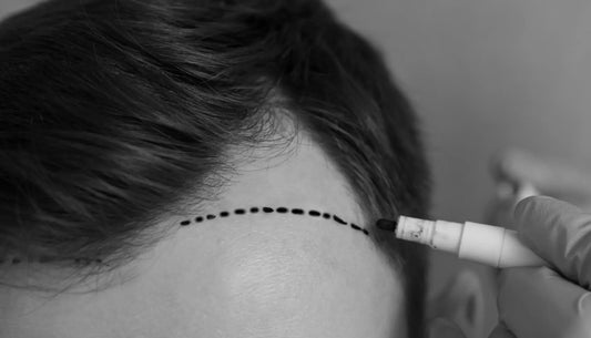 Hair Transplant Recovery Guide for Men: Aftercare & Products